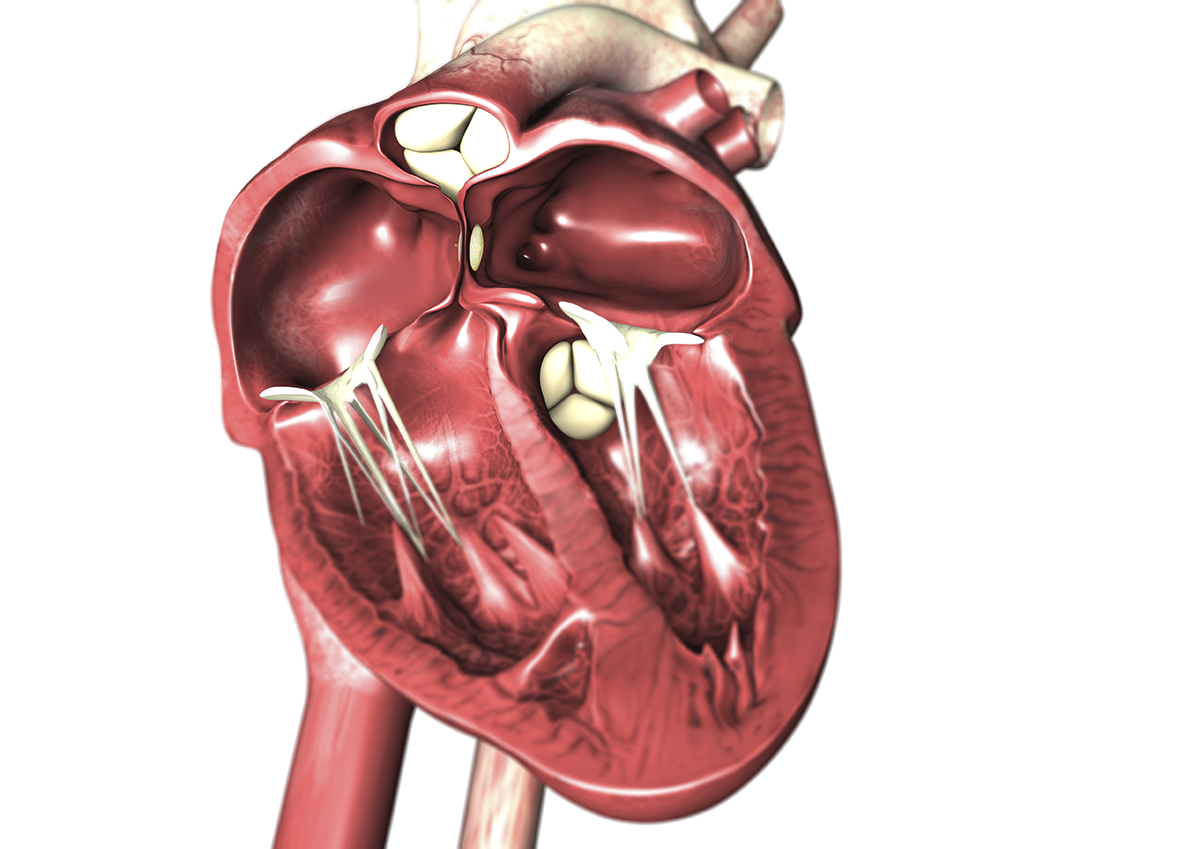 Persistierendes Foramen ovale (PFO)