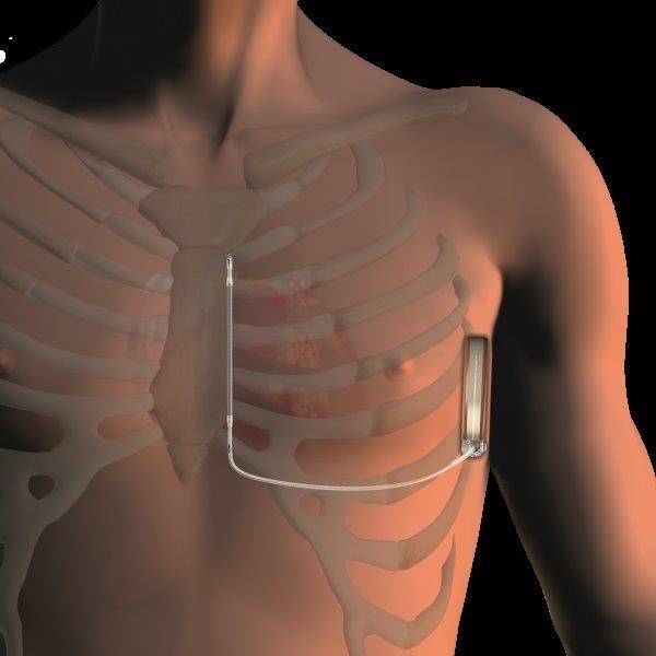 Subkutaner implantierbarer Cardioverter-Defibrillator (S-ICD)